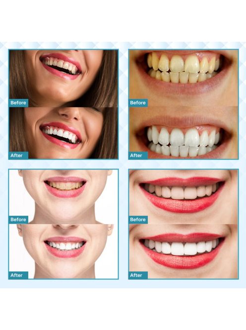 Professional Teeth Whitening Kit 